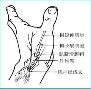手腕腱鞘炎