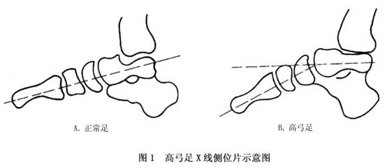 高弓足