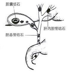 治疗胆结石的