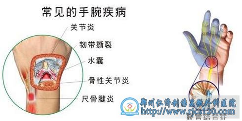 什么是腕管综合征