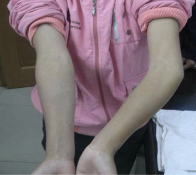 肘外翻的原因