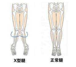 膝外翻手术多少钱