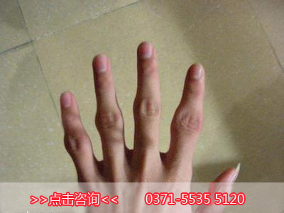 治疗纽扣指方法