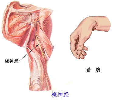 桡神经损伤能恢复吗?桡神经损伤怎么恢复?